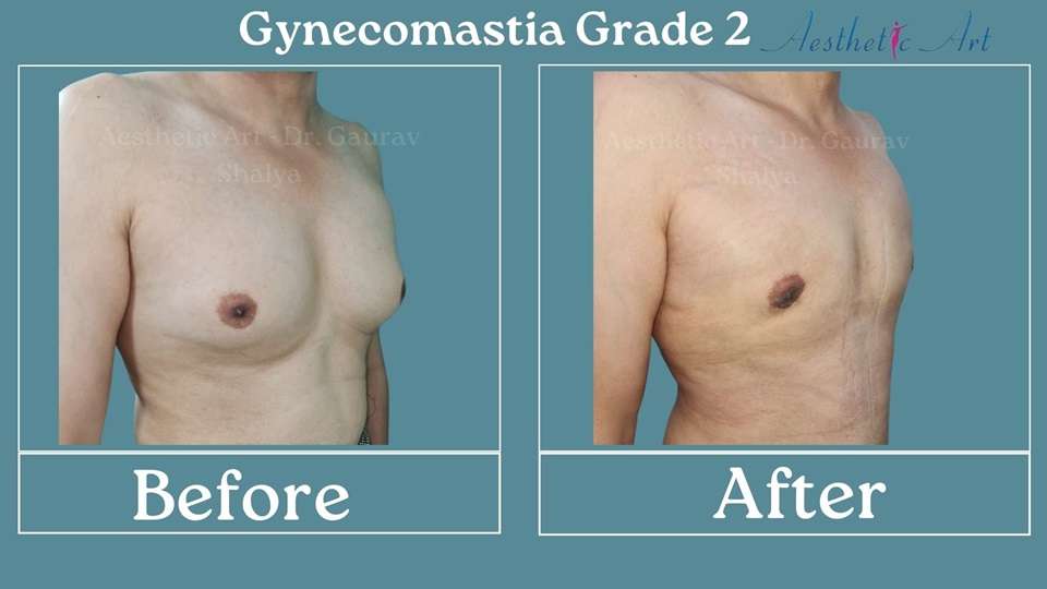 What is gynecomastia