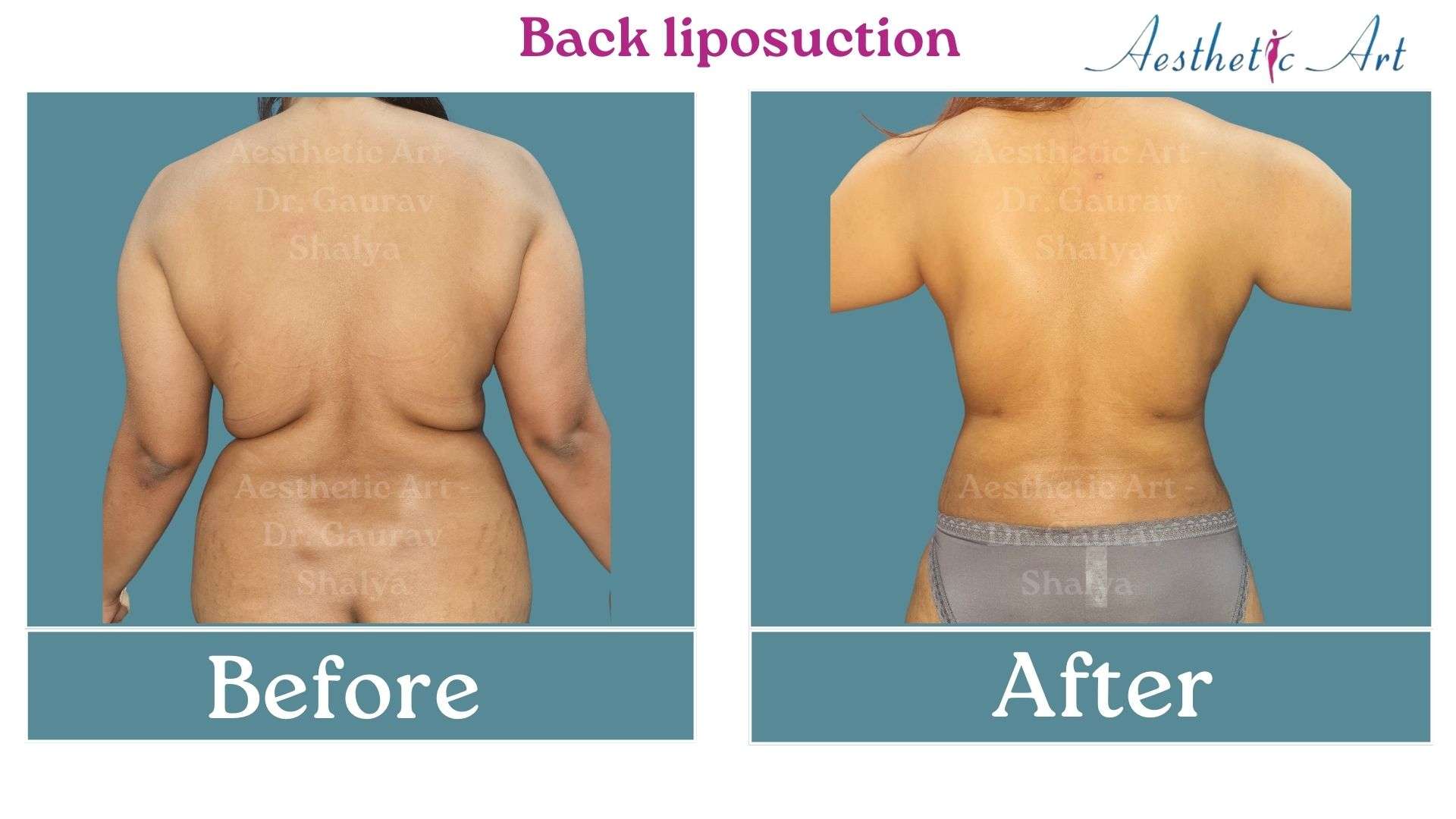Back liposuction - Aesthetic Art Plastic Surgeon Mumbai