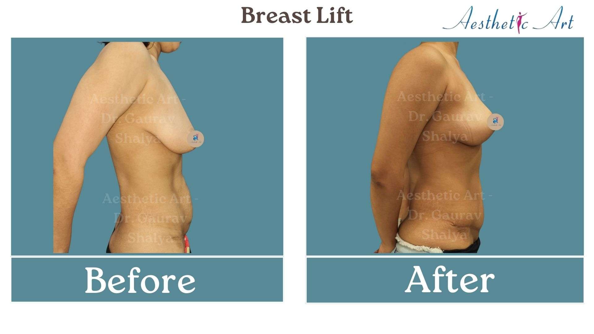 breast lift remove fat