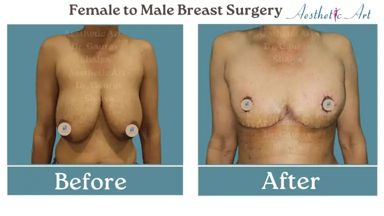 Female to Male Surgery